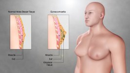 Gynecomastia.jpeg